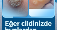 İşte Tedavisi..
