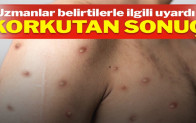 Maymun çiçeği semptomları önceki salgınlardan farklı