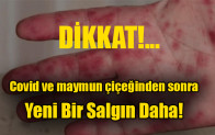 Covid ve maymun çiçeğinden sonra yeni bir salgın daha