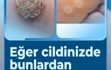 İşte Tedavisi..