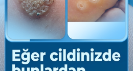 İşte Tedavisi..