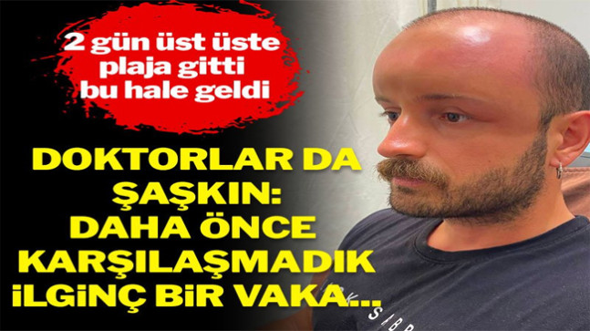 2 gün üst üste plaja gitti bu hale geldi