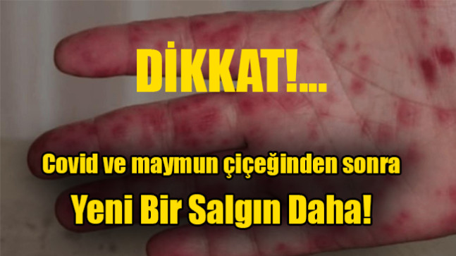 Covid ve maymun çiçeğinden sonra yeni bir salgın daha