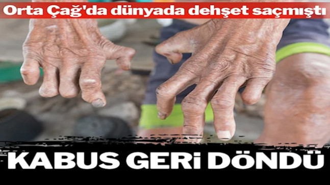 Eski dönemlerin korkutucu hastalığıydı: Yeniden yükselişte!