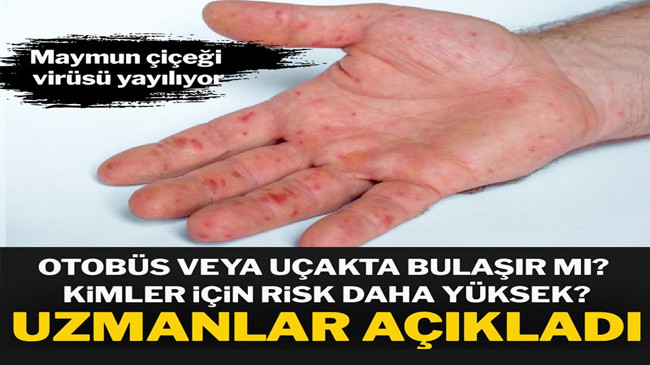 Maymun çiçeği virüsü Uçakta bulaşır mı? Peki risk grubunda olanlar kimler?